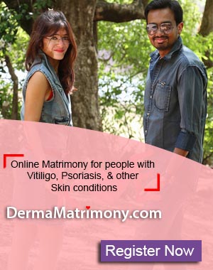 Vitiligo leucoderma white spots marriage matrimony